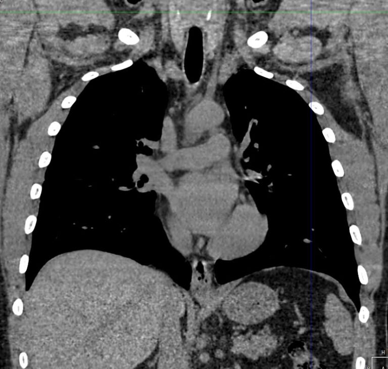 КТ органов средостения