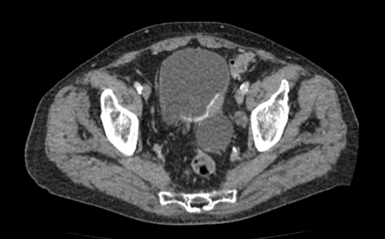 КТ при раке мочевого пузыря