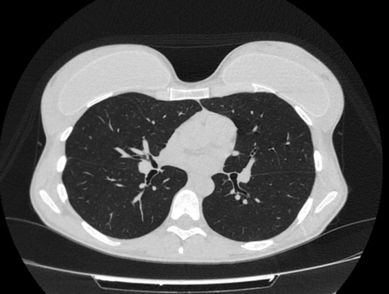 Компьютерная томография легких. Аксиальная плоскость. Состояние после аугментационной маммопластики.