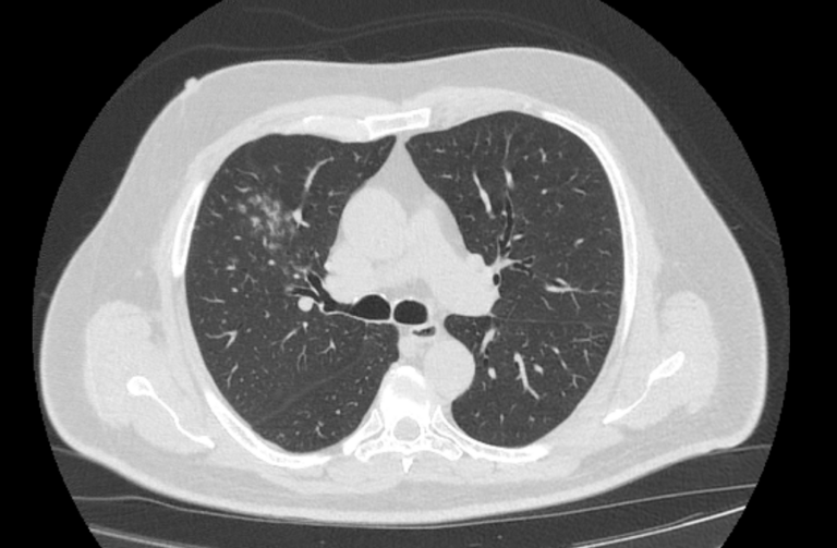 Компьютерная томография легких. Перибронхиальные очаги по типу матового стекла при бронхиолите.