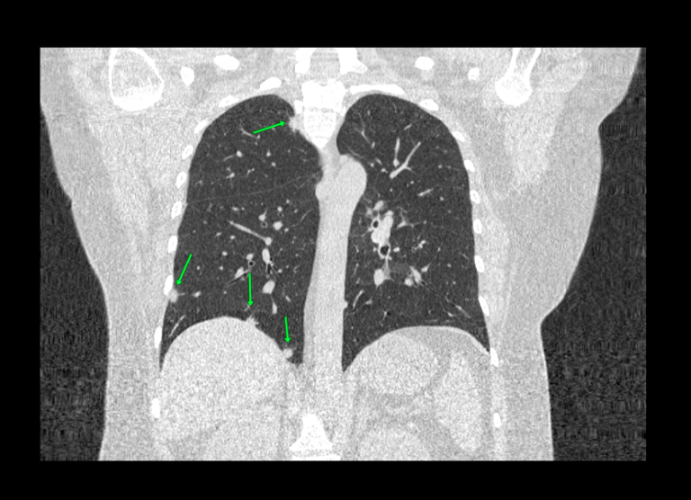 Компьютерная томография легких. Стрелочками указаны метастазы рака молочной железы в правом легком.