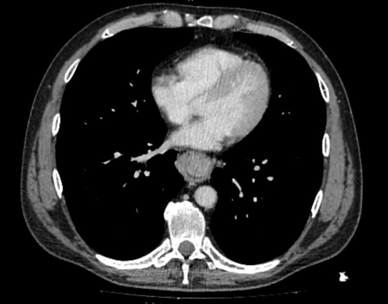 КТ пищевода
