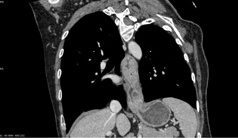 КТ пищевода
