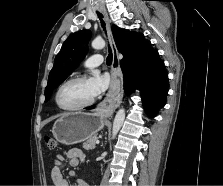 КТ пищевода