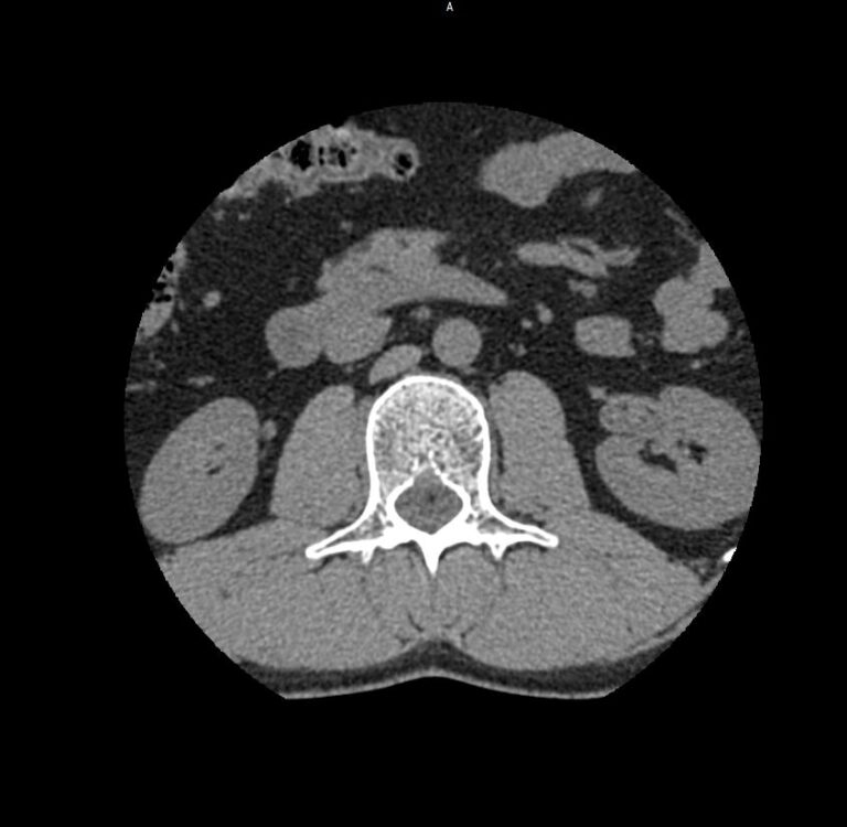КТ пояснично-крестцового отдела позвоночника