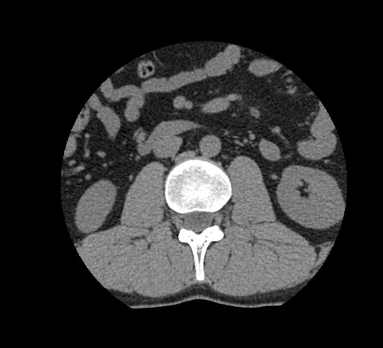 КТ пояснично-крестцового отдела позвоночника