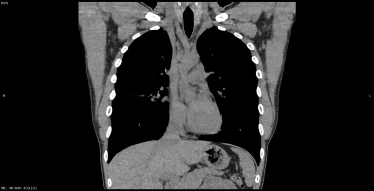 КТ лимфатических узлов