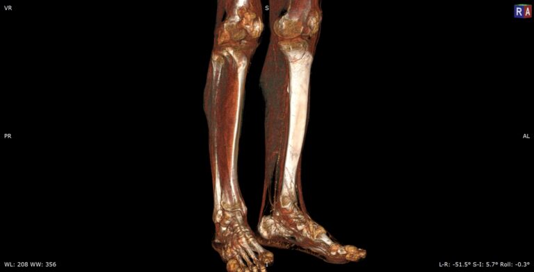 КТ сосудов нижних конечностей