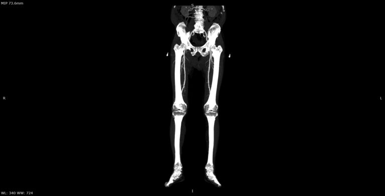 КТ сосудов нижних конечностей