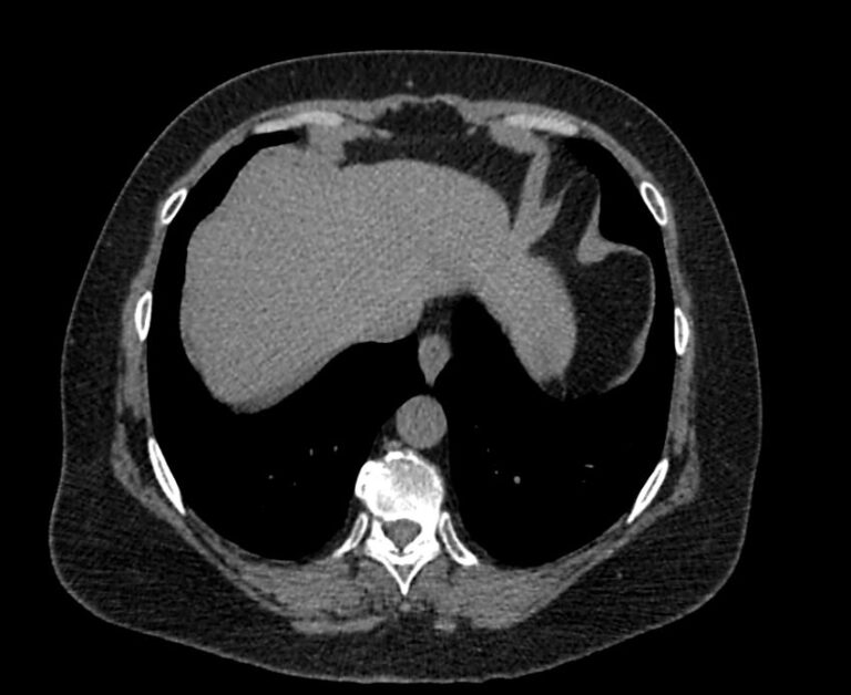 КТ органов брюшной полости