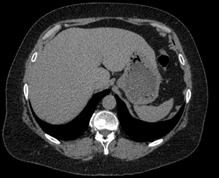 КТ органов брюшной полости