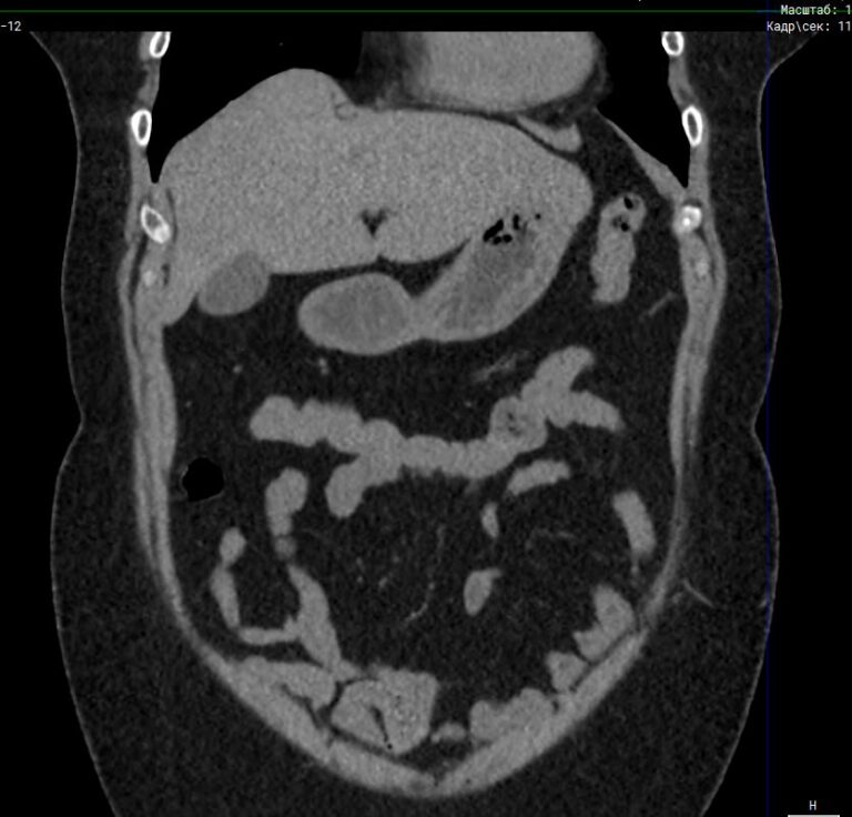 КТ органов брюшной полости