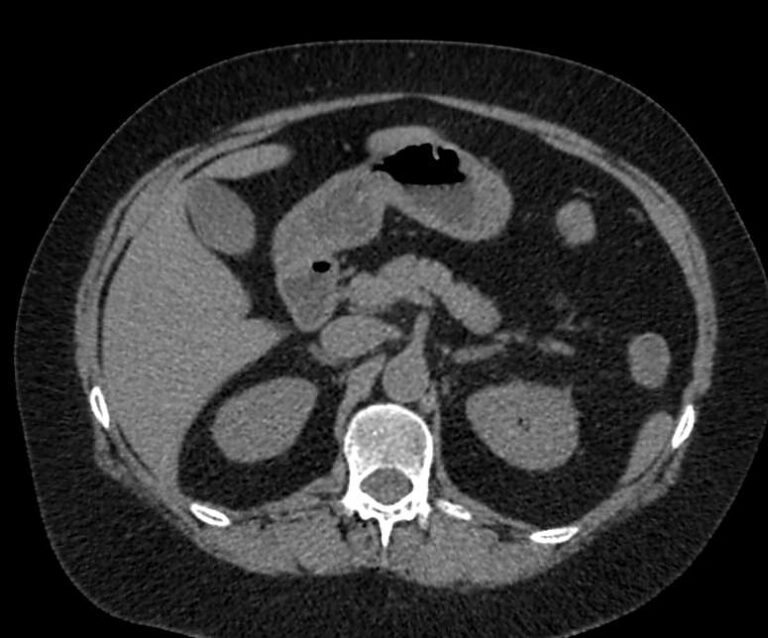 КТ органов брюшной полости