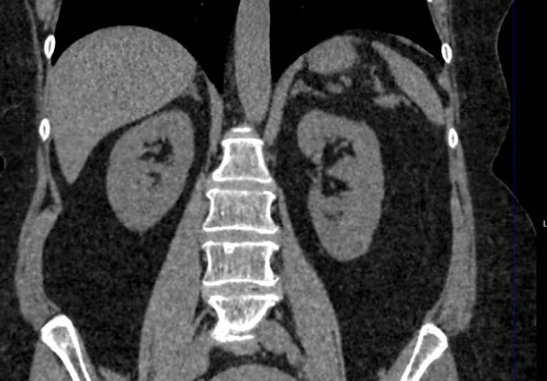 КТ забрюшинного пространства