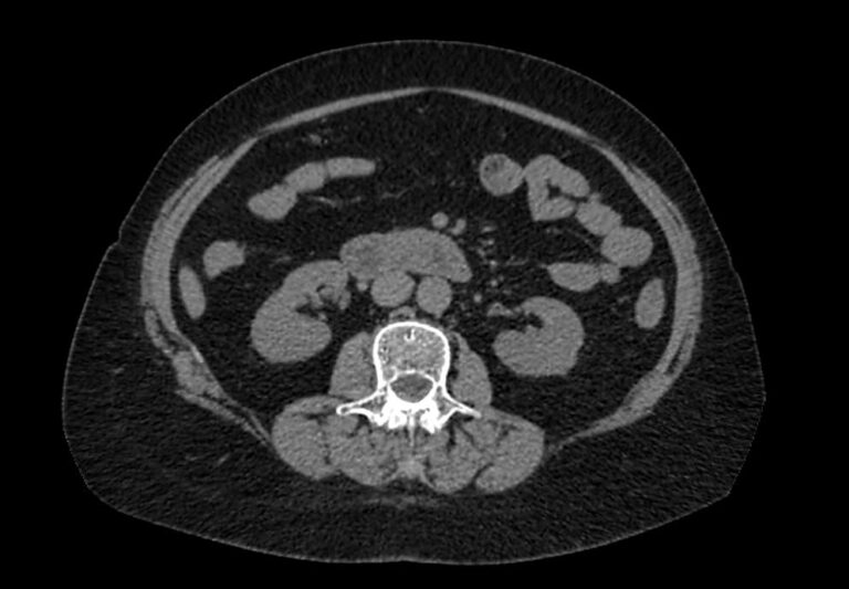 КТ органов брюшной полости