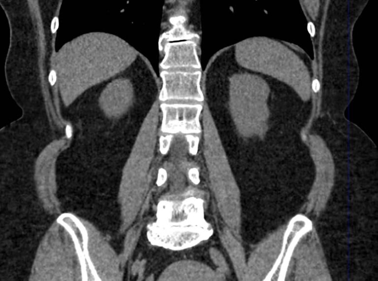 КТ органов брюшной полости