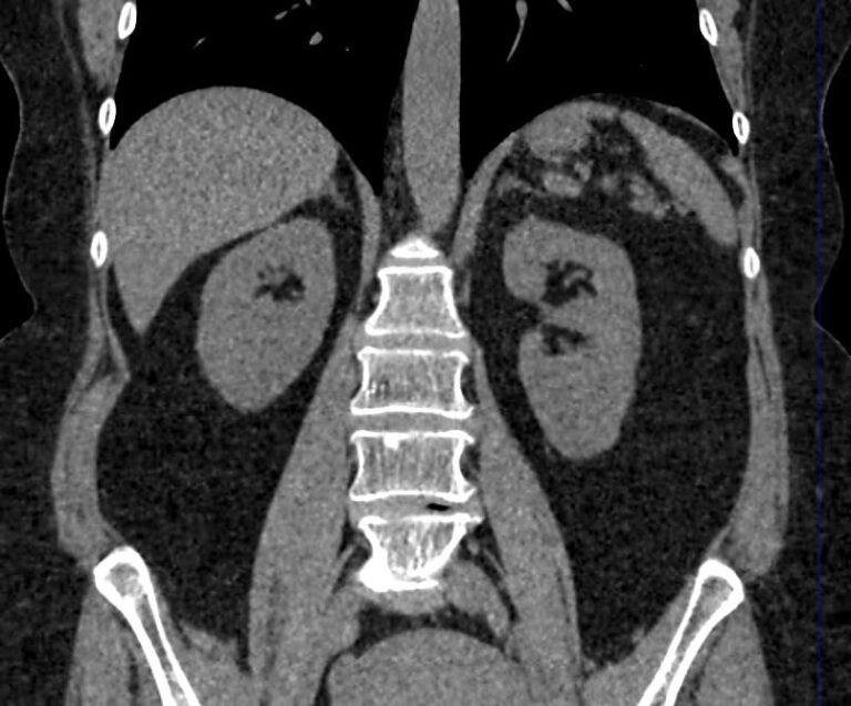 КТ органов брюшной полости