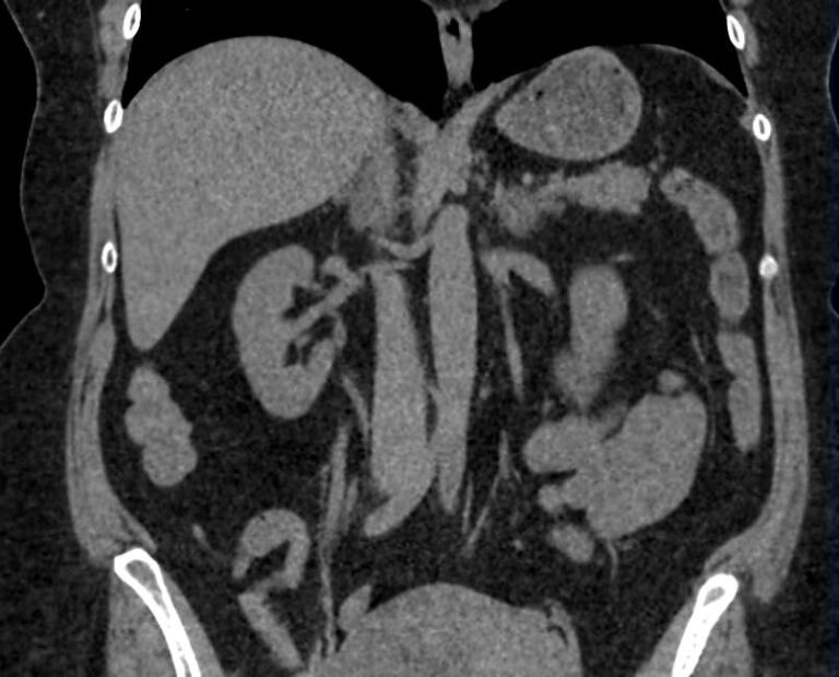 КТ органов брюшной полости