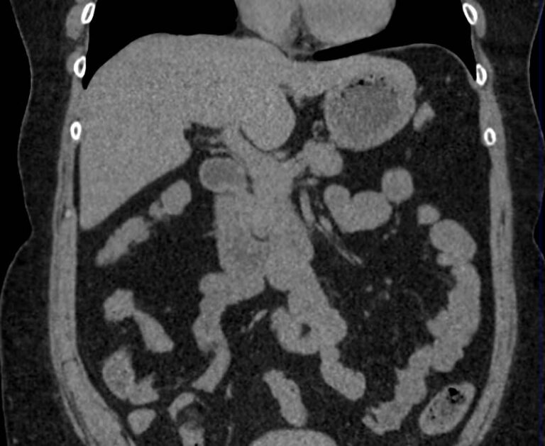 КТ органов брюшной полости