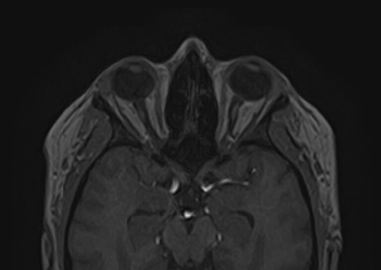 МРТ головного мозга + МРТ орбит