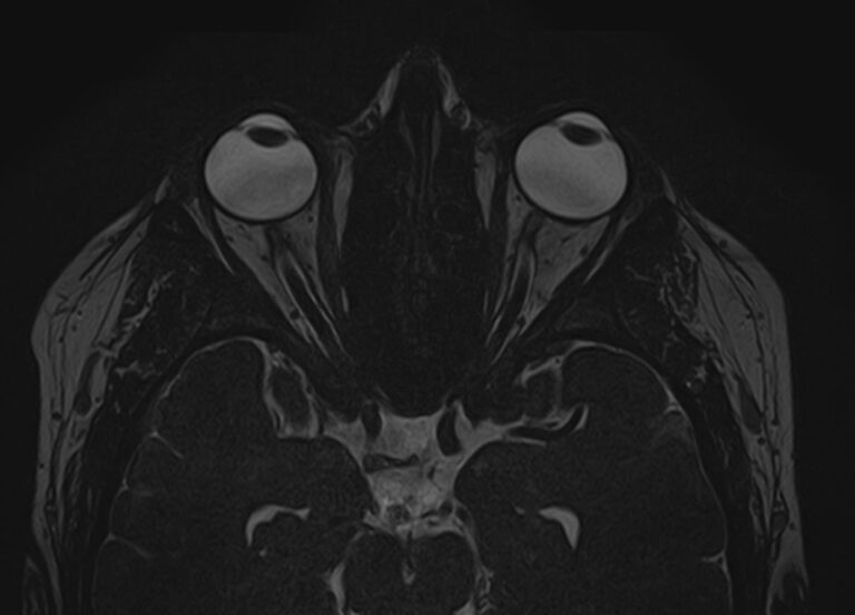МРТ головного мозга + МРТ орбит