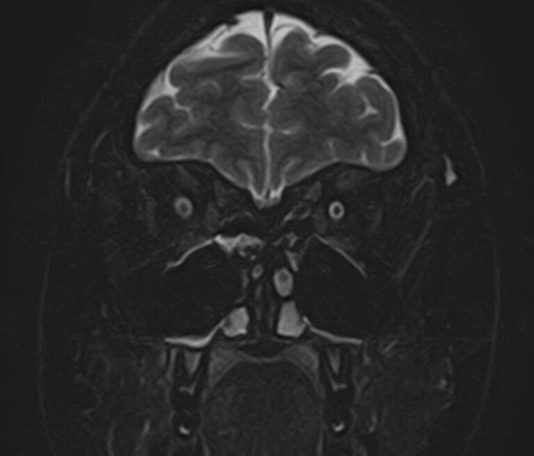 МРТ головного мозга + МРТ орбит