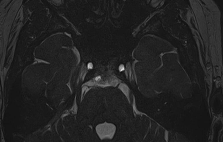 МРТ головного мозга + черепно-мозговые нервы