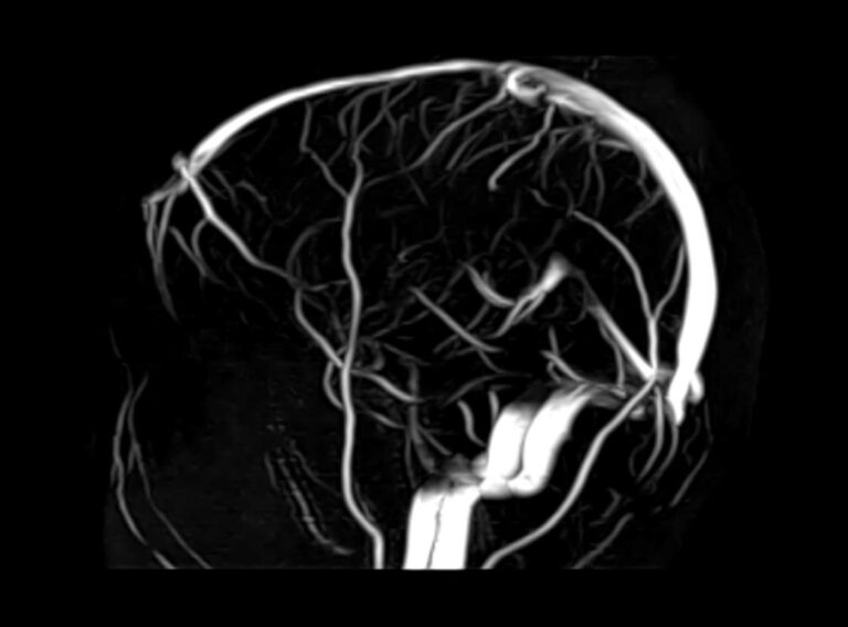 МРТ головного мозга и МР-венография головного мозга