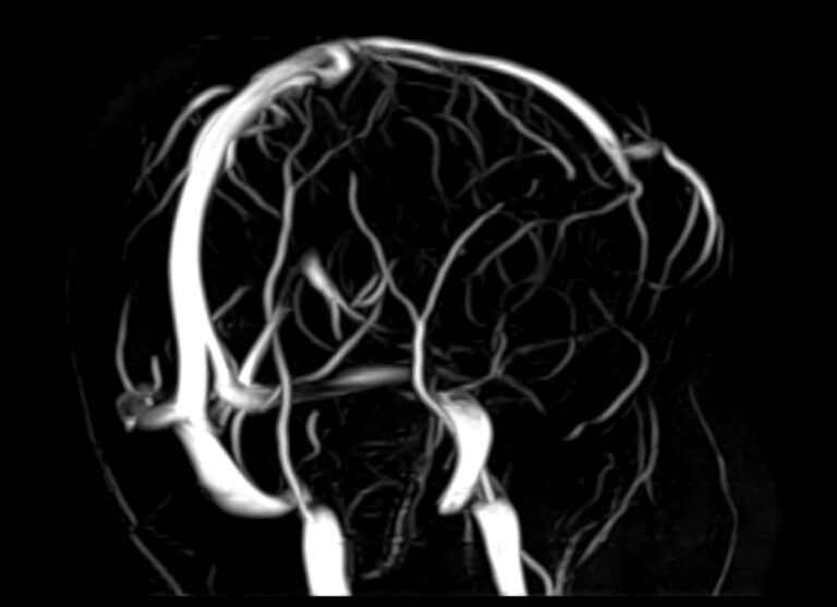 МРТ головного мозга и МР-венография головного мозга