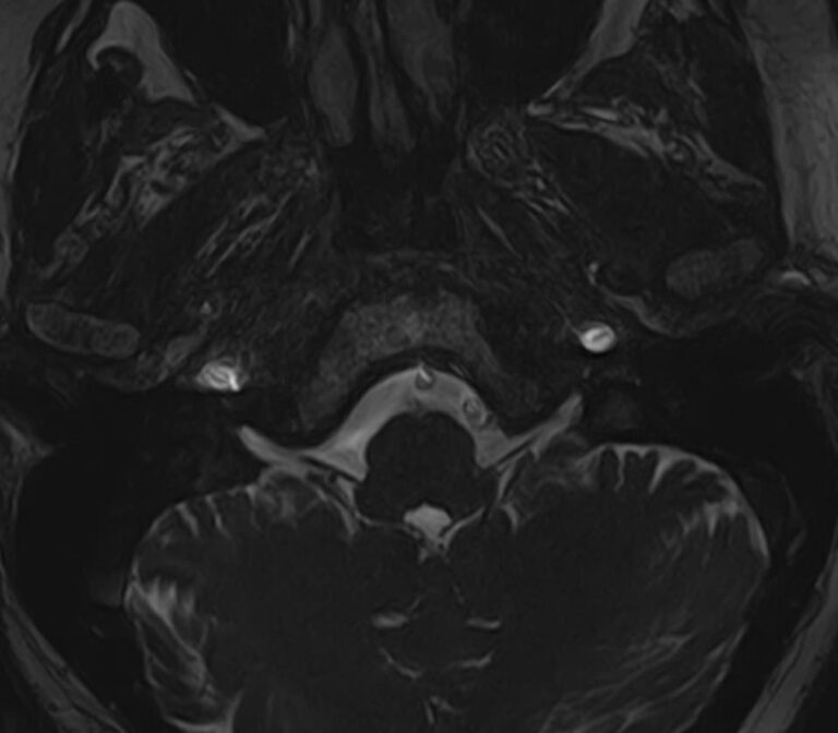 МРТ головного мозга+мосто-мозжечкового угла