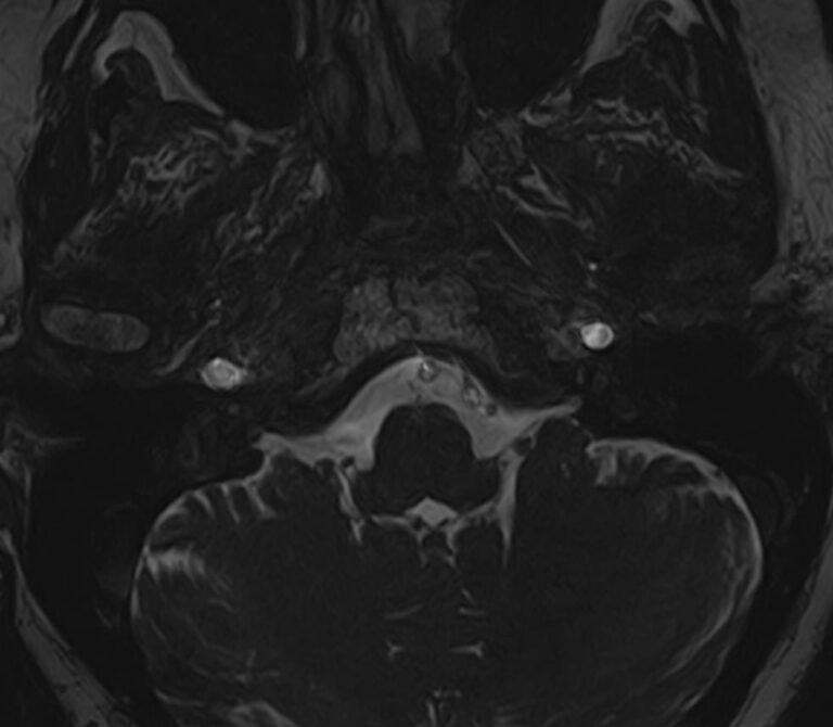 МРТ головного мозга+мосто-мозжечкового угла