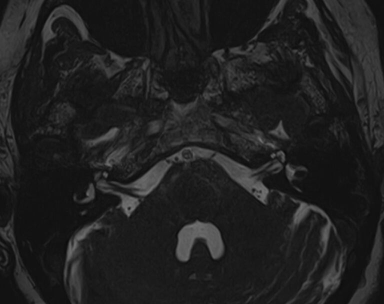 МРТ головного мозга+мосто-мозжечкового угла