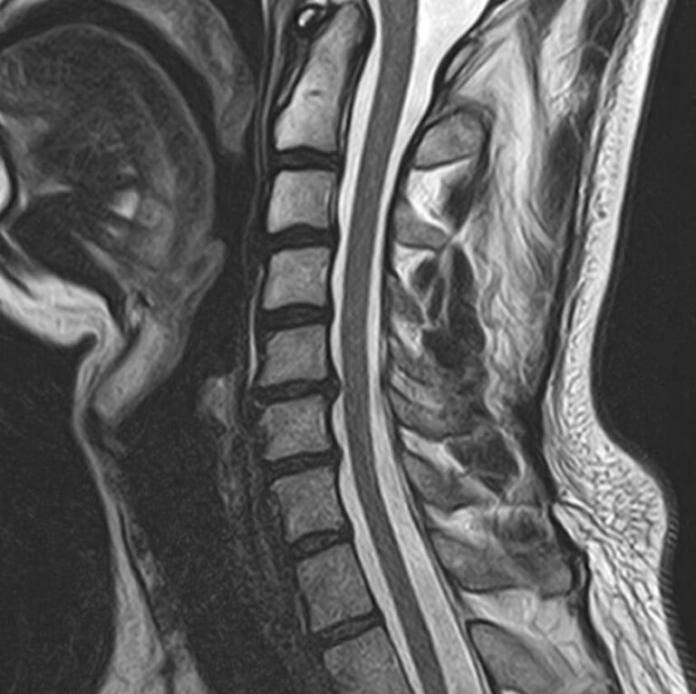 МРТ одного отдела позвоночника
