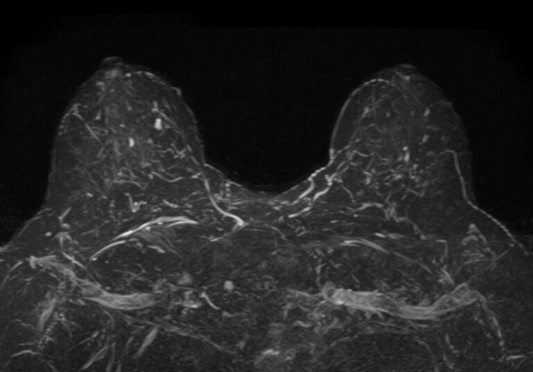 МРТ молочных желез