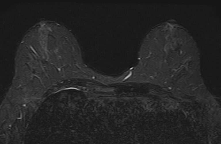 МРТ молочных желез