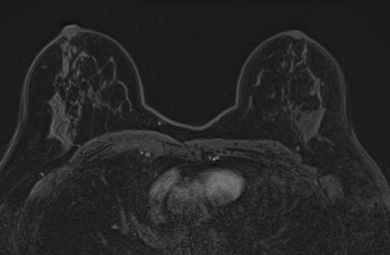 МРТ молочных желез