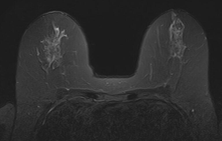 МРТ молочных желез