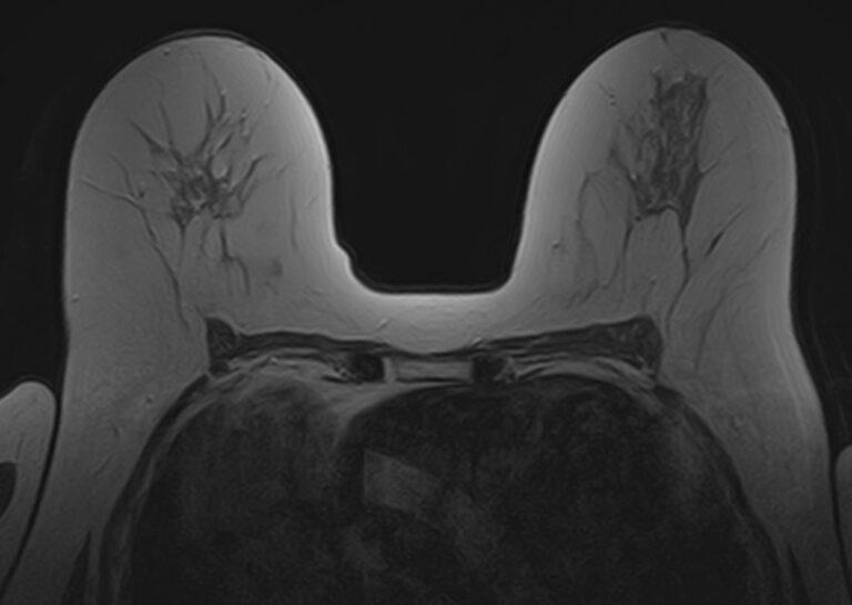 МРТ молочных желез