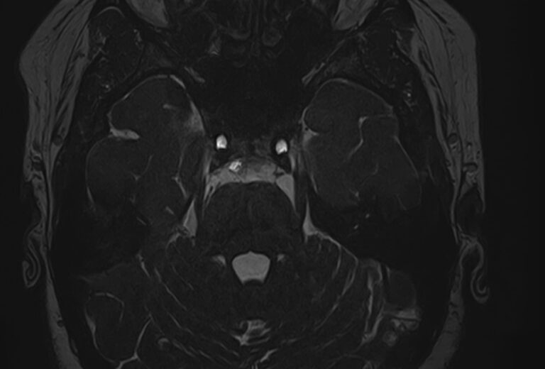 МРТ головного мозга + Мр-ангиография головного мозга + МР-венография головного мозга + черепно-мозговые нервы