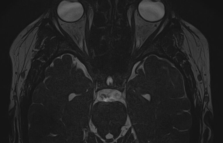 МРТ головного мозга + Мр-ангиография головного мозга + МР-венография головного мозга + черепно-мозговые нервы