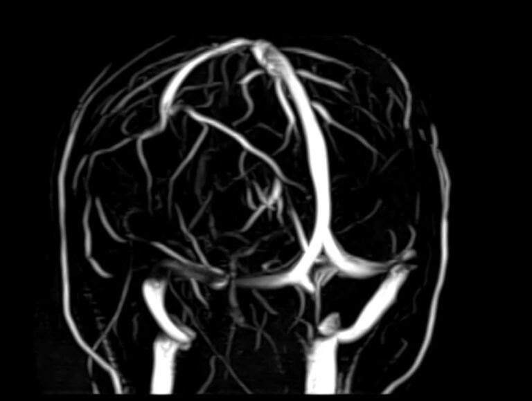 МРТ головного мозга + МР-ангиография головного мозга + МР-венография головного мозга