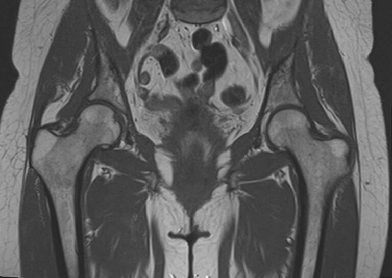 МРТ пояснично-крестцового отдела позвоночника + МРТ тазобедренных суставов