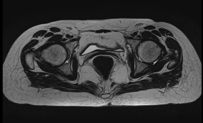 МРТ пояснично-крестцового отдела позвоночника + МРТ тазобедренных суставов