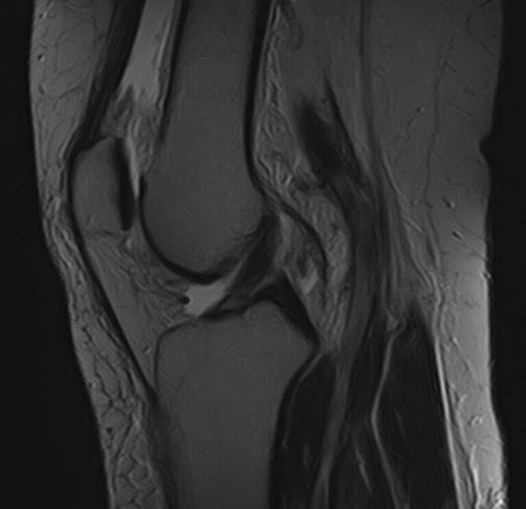 МРТ пояснично-крестцового отдела позвоночника + МРТ коленного сустава