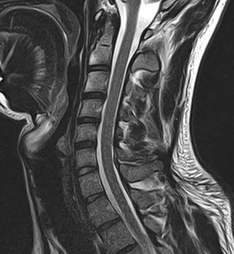 МРТ головного мозга + МРТ шейного отдела позвоночника + МР-ангиография шеи и головного мозга