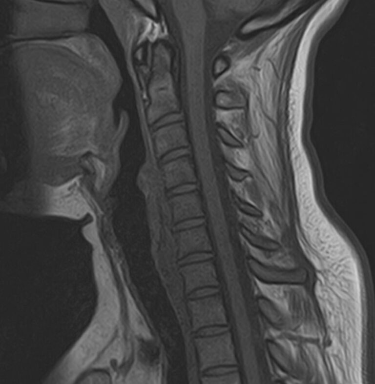 МРТ головного мозга + МРТ шейного отдела позвоночника + МР-ангиография шеи и головного мозга