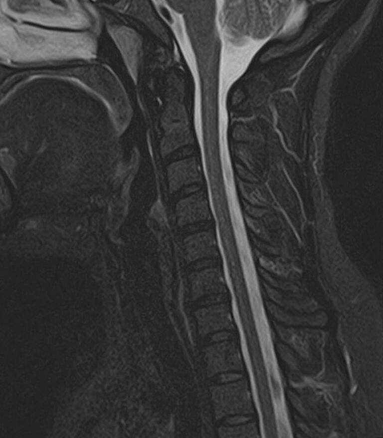 МРТ головного мозга + МРТ шейного отдела позвоночника + МР-ангиография шеи и головного мозга
