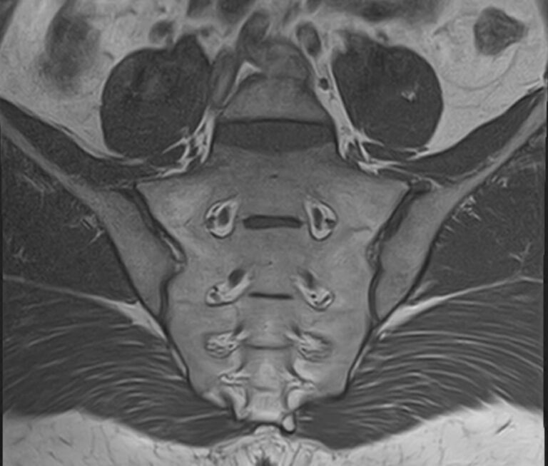 МРТ пояснично-крестцового отдела позвоночника + МРТ крестцово-подвздошных сочленений