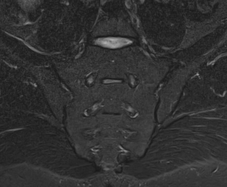 МРТ пояснично-крестцового отдела позвоночника + МРТ крестцово-подвздошных сочленений