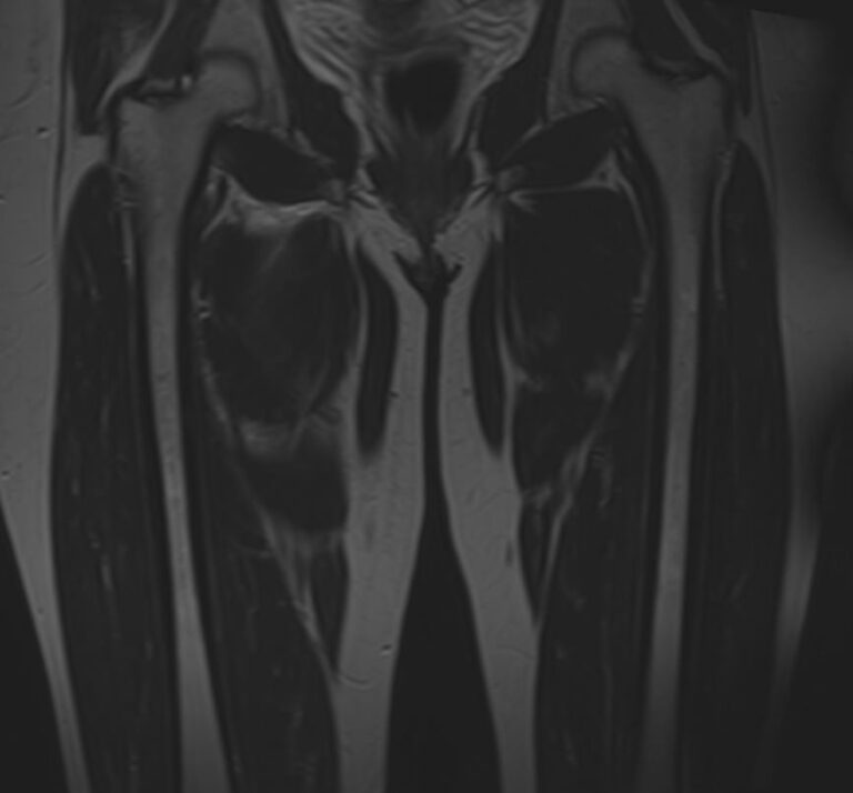 МРТ мягких тканей конечностей